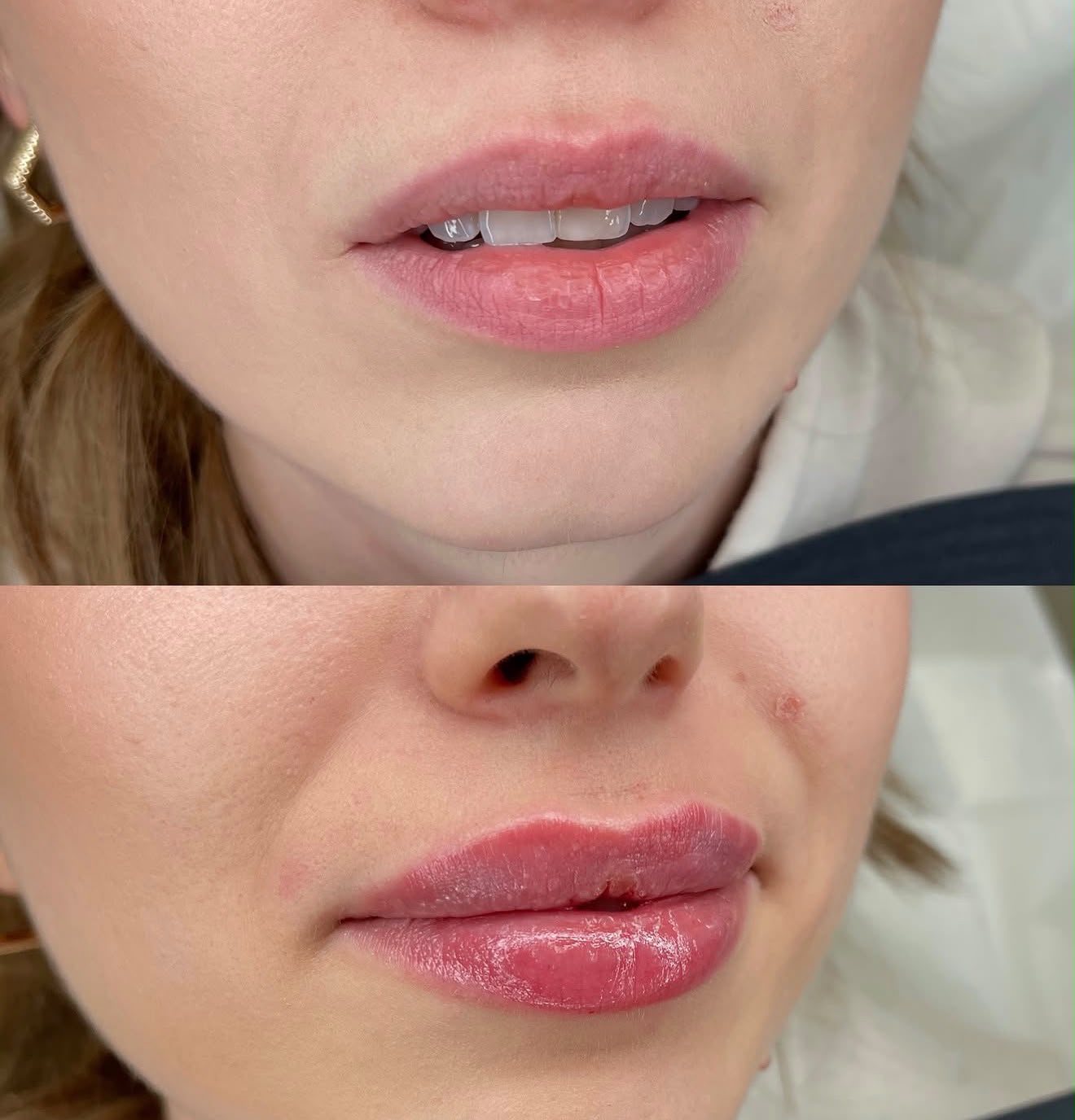 Pre i posle – fileri usana