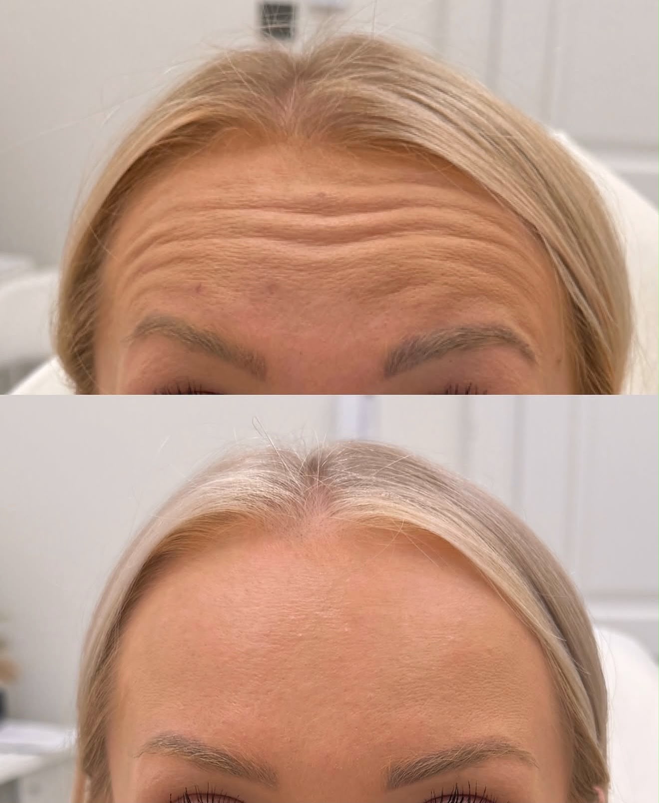Pre i posle – Botox čela